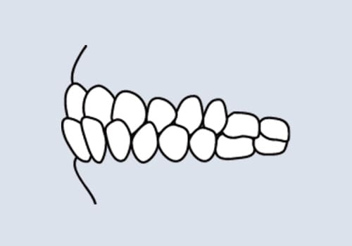 反対咬合（受け口・下顎前突）
