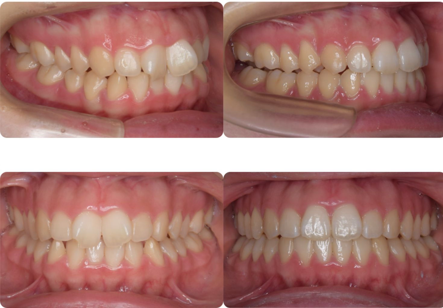 叢生・非対称／非抜歯症例*