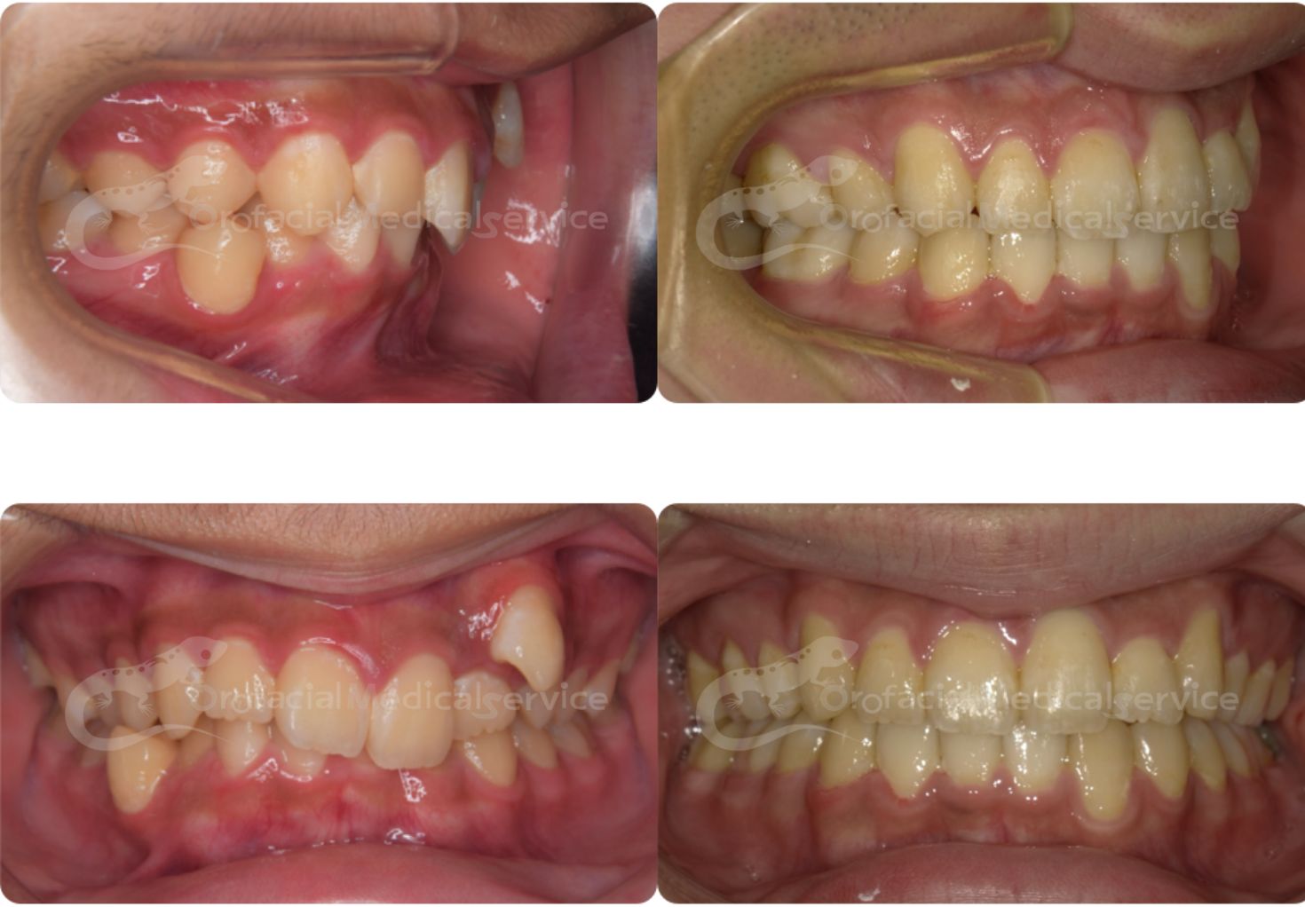 叢生・非対称／抜歯症例*